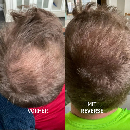 ReverseHair™ | Haarwuchsbooster