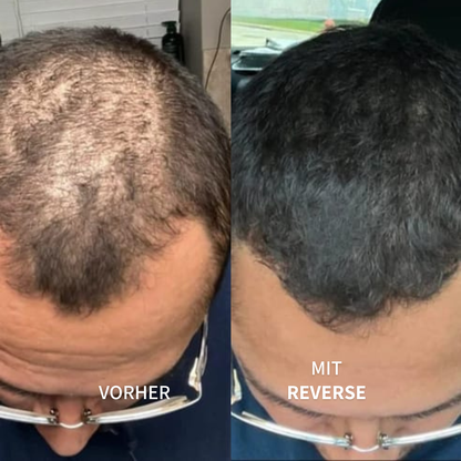 ReverseHair™ | Haarwuchsbooster