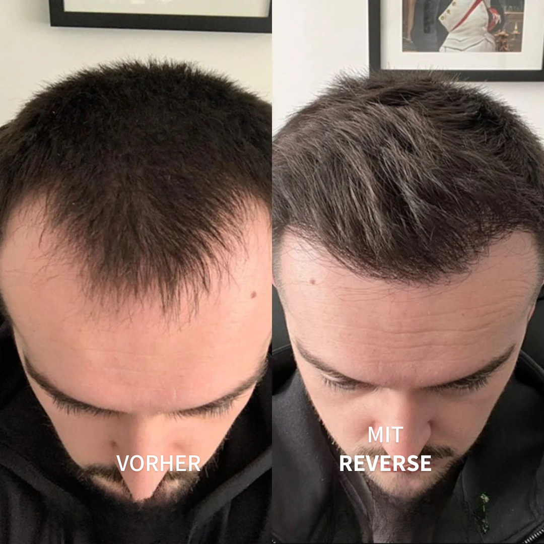 ReverseHair™ | Haarwuchsbooster